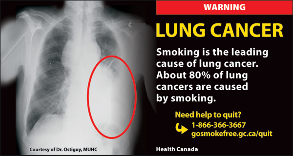 Canada 2012 Health Effects lung - xray, lung cancer - cigar eng